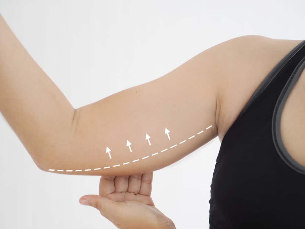 Non Surgical Arm Fat Removal