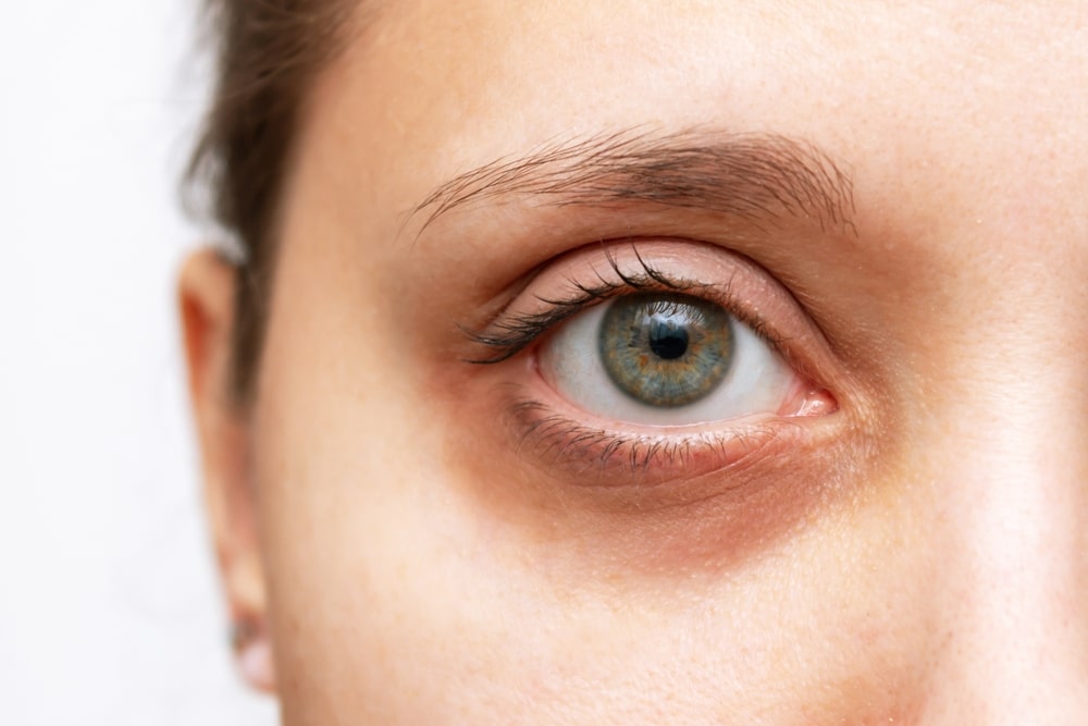 Eye dark circles