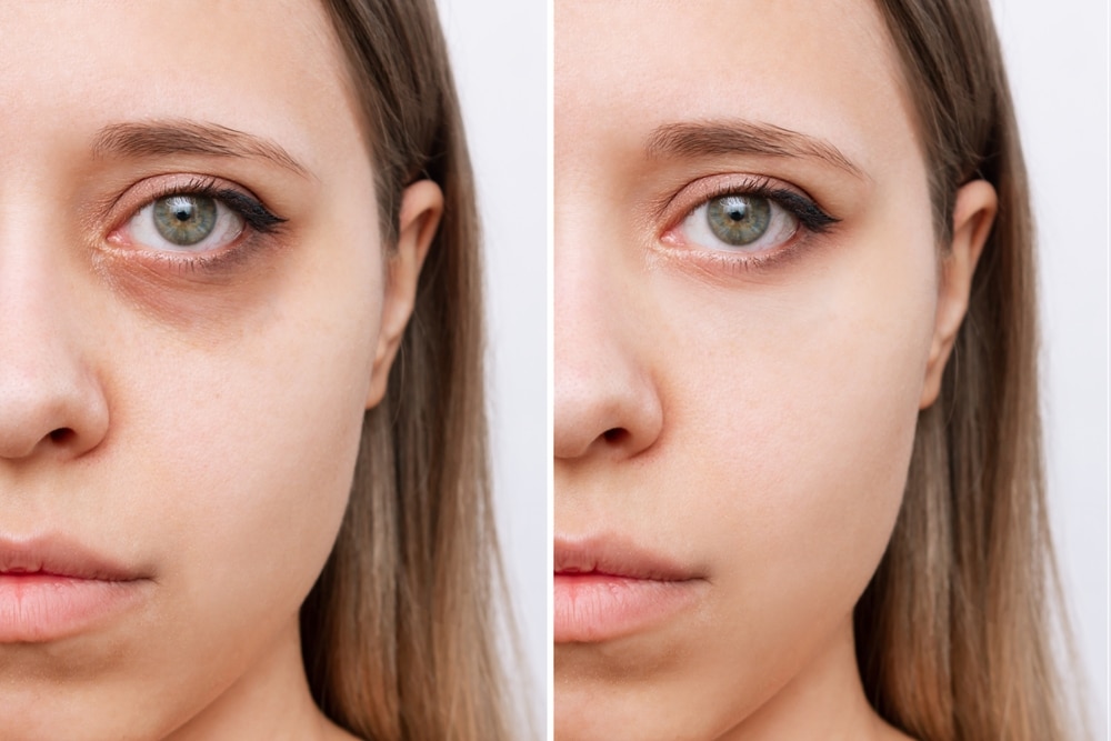 Frame of a young Caucasian woman's face with dark circles under her eyes before and after cosmetic treatment
