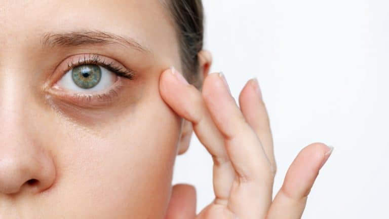 Laser Therapy for Dark Eye Circles