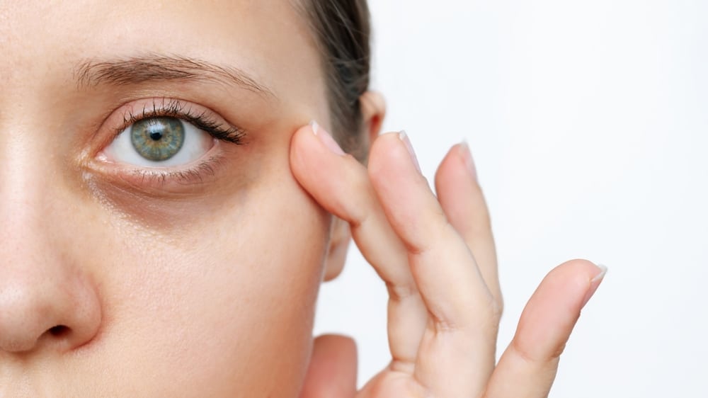 Laser Therapy for Dark Eye Circles