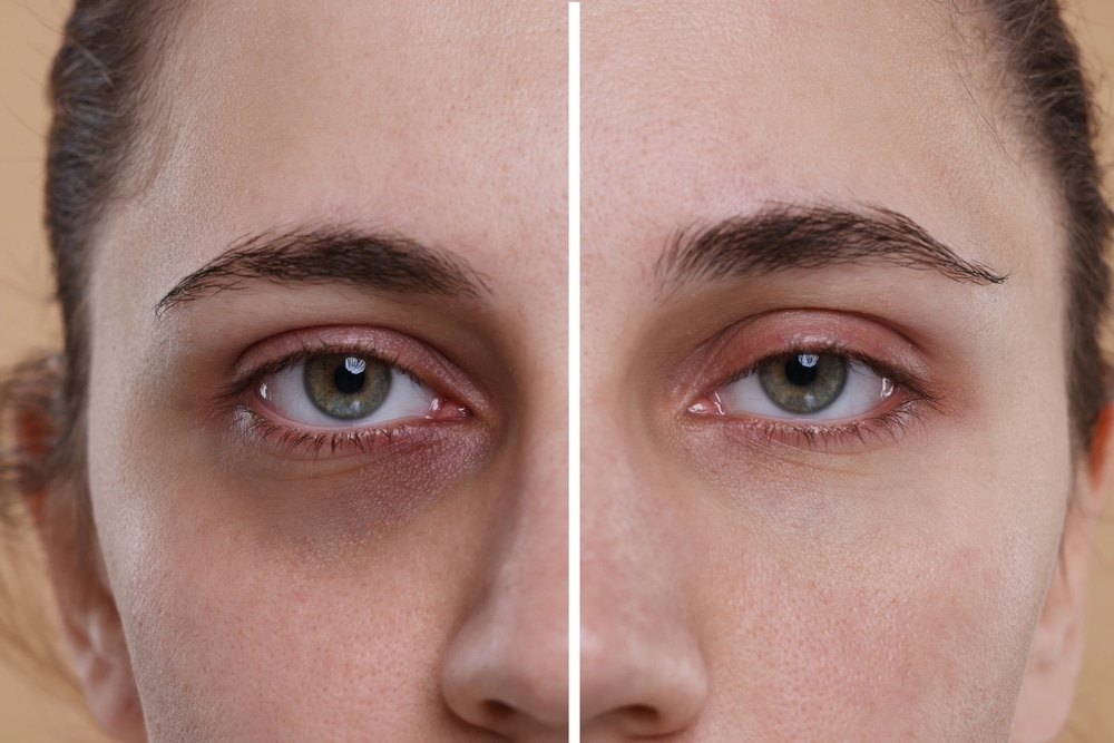 Therapy for dark circles on eyes